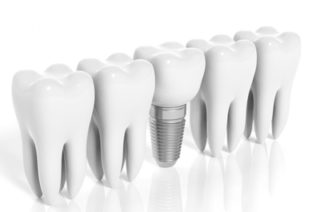 https://adent.com.ua/wp-content/uploads/2015/11/implant-320x212.jpg